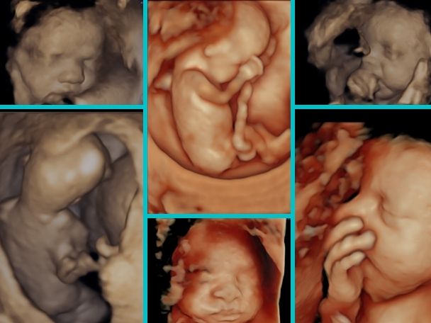 3d and 4d ultrasound pictures