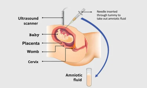 Amniodrainage & Amnioinfusion