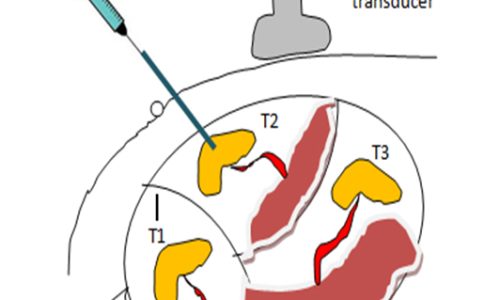 Multifetal-Pregnancy-Reduction