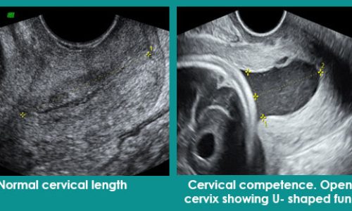 cervical-length