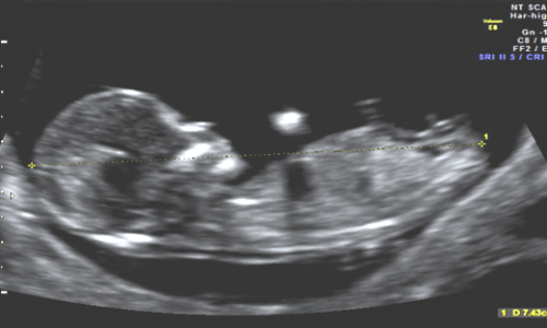 first-trimester-combined-screening