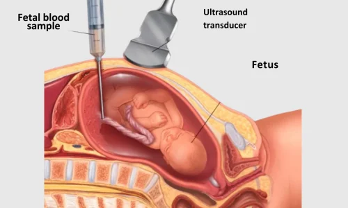 percutaneous-umbilical-blood-sampling