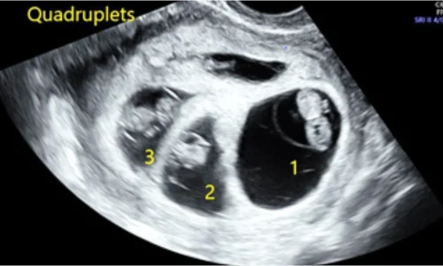 ultrasound transducer (1)